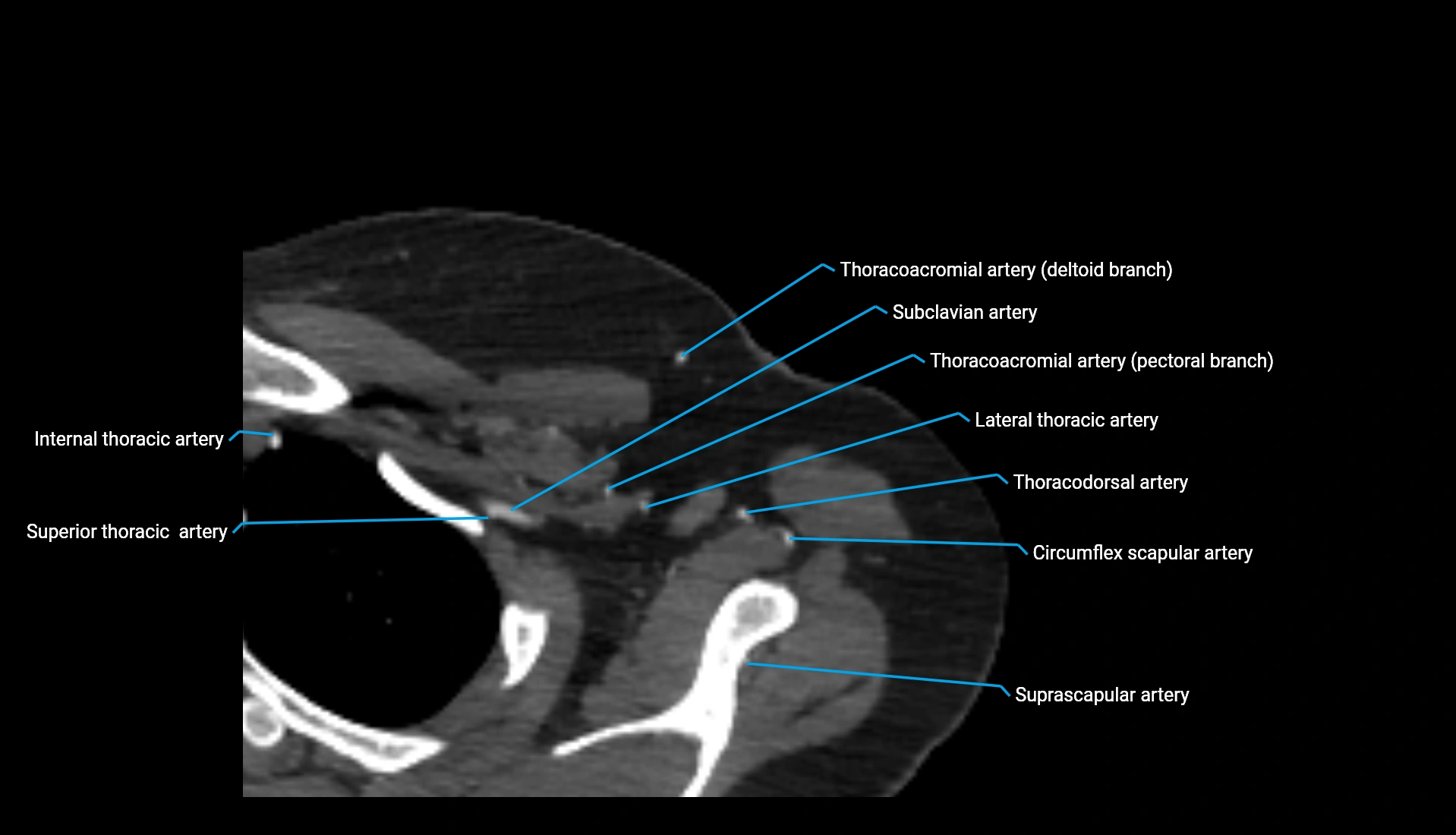 CTA upper limb axial cross sectional anatomy labelled image 339 (1).webp
